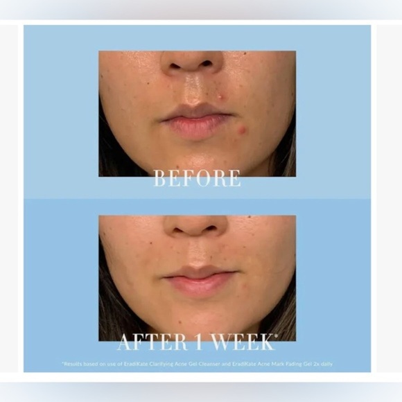 Kate Somerville Eradikate Acne Mark Fading Gel new - Picture 5 of 9